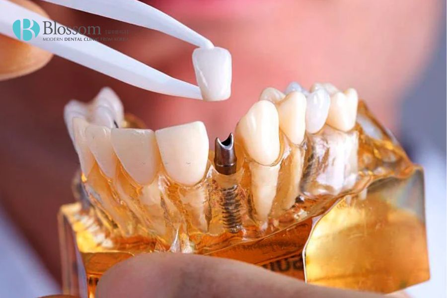 Hướng dẫn quy trình cắm Implant chi tiết, chuẩn Y khoa 7 quy trinh cam implant 6