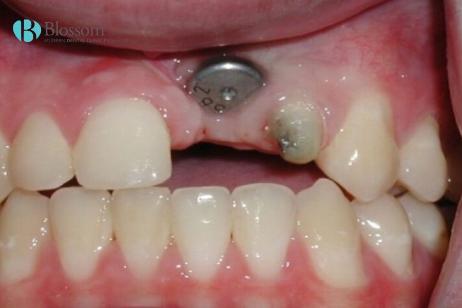 Hướng dẫn quy trình cắm Implant chi tiết, chuẩn Y khoa 9 quy trinh cam implant 8