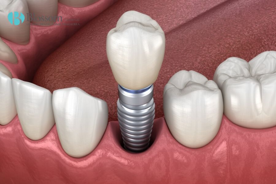 Hướng dẫn quy trình cắm Implant chi tiết, chuẩn Y khoa 10 quy trinh cam implant 9 1
