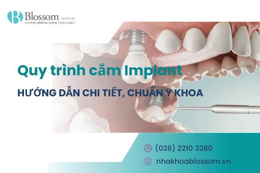 Hướng dẫn quy trình cắm Implant chi tiết, chuẩn Y khoa