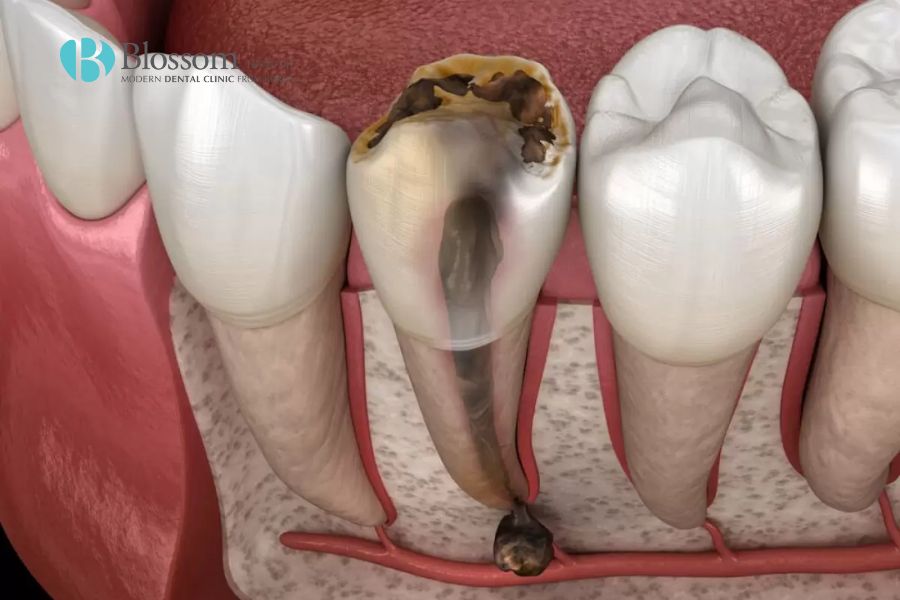Răng bị đổi màu nguyên nhân do đâu? Cách khắc phục ra sao? 2 rang bi doi mau 1
