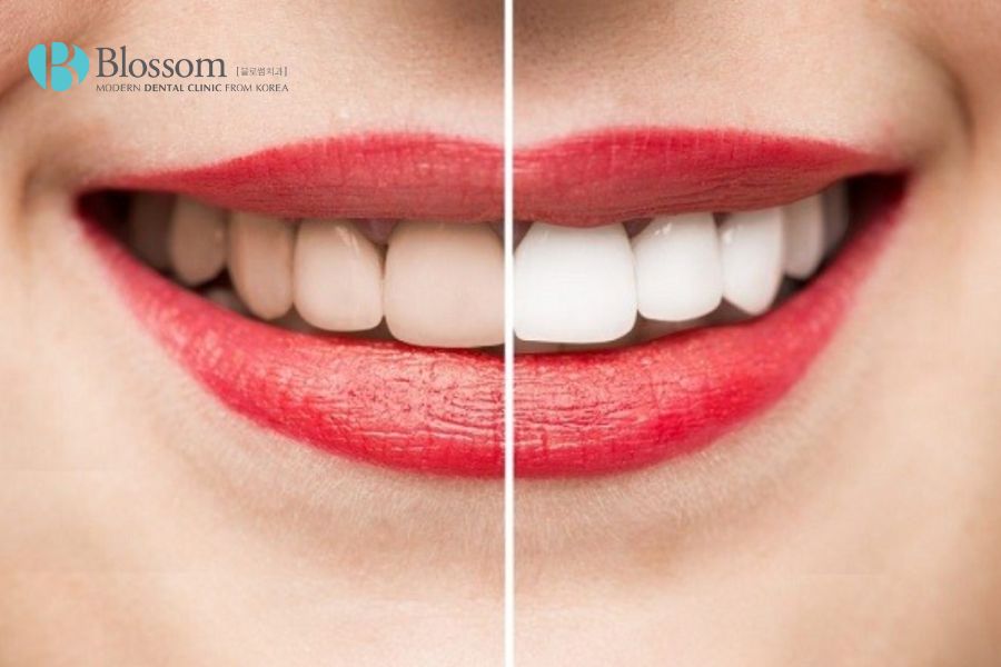 Răng bị đổi màu nguyên nhân do đâu? Cách khắc phục ra sao? 8 rang bi doi mau 7