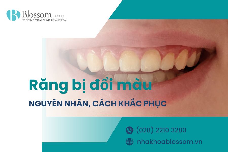 Răng bị đổi màu nguyên nhân do đâu? Cách khắc phục ra sao?