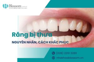Răng bị thưa do đâu? Làm thế nào để cải thiện tình trạng răng thưa hiệu quả?