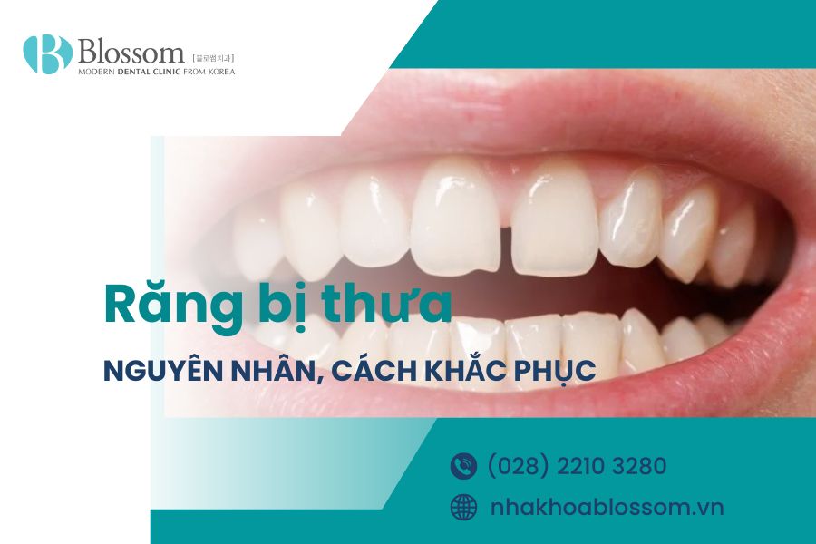 Răng bị thưa do đâu? Làm thế nào để cải thiện tình trạng răng thưa hiệu quả?