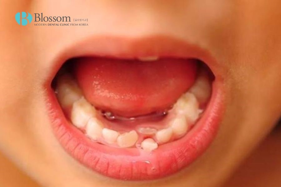 Răng bị thưa do đâu? Làm thế nào để cải thiện tình trạng răng thưa hiệu quả? 3 rang bi thua 2