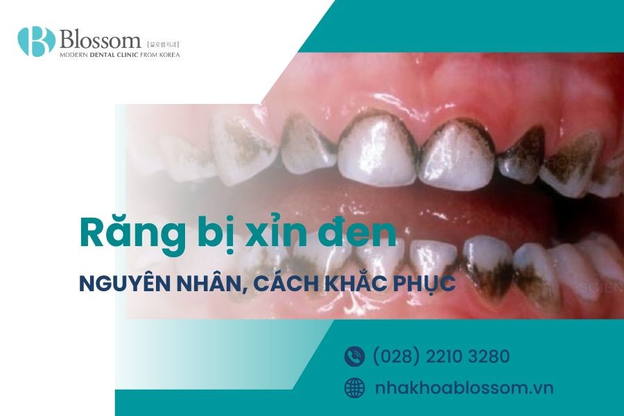 Răng bị xỉn đen nguyên nhân do đâu? Cách khắc phục hiệu quả
