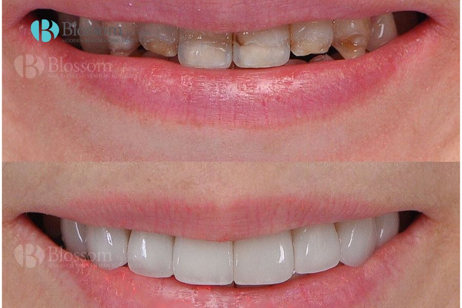 Răng bị xỉn đen nguyên nhân do đâu? Cách khắc phục hiệu quả 11 rang bi xin den 14