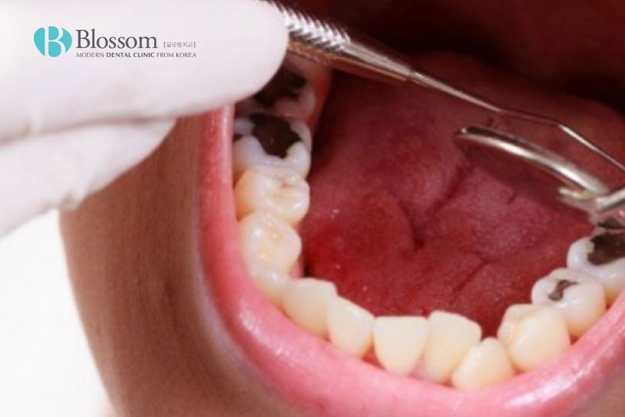 Răng bị xỉn đen nguyên nhân do đâu? Cách khắc phục hiệu quả 5 rang bi xin den 4