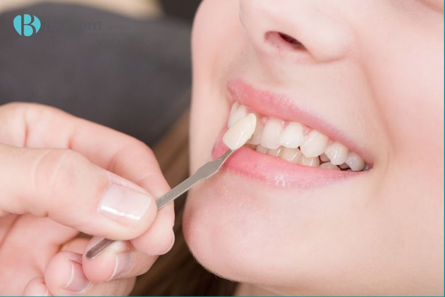 Răng xỉn màu là bị gì và cách khắc phục răng xỉn màu 14 rang bi xin mau 13