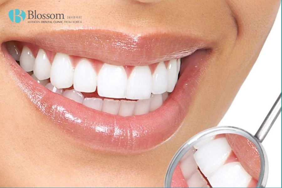 Răng xỉn màu là bị gì và cách khắc phục răng xỉn màu 4 rang bi xin mau 3