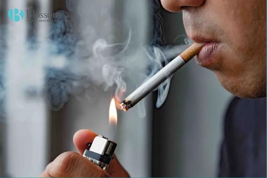 Răng xỉn màu là bị gì và cách khắc phục răng xỉn màu 7 rang bi xin mau 6
