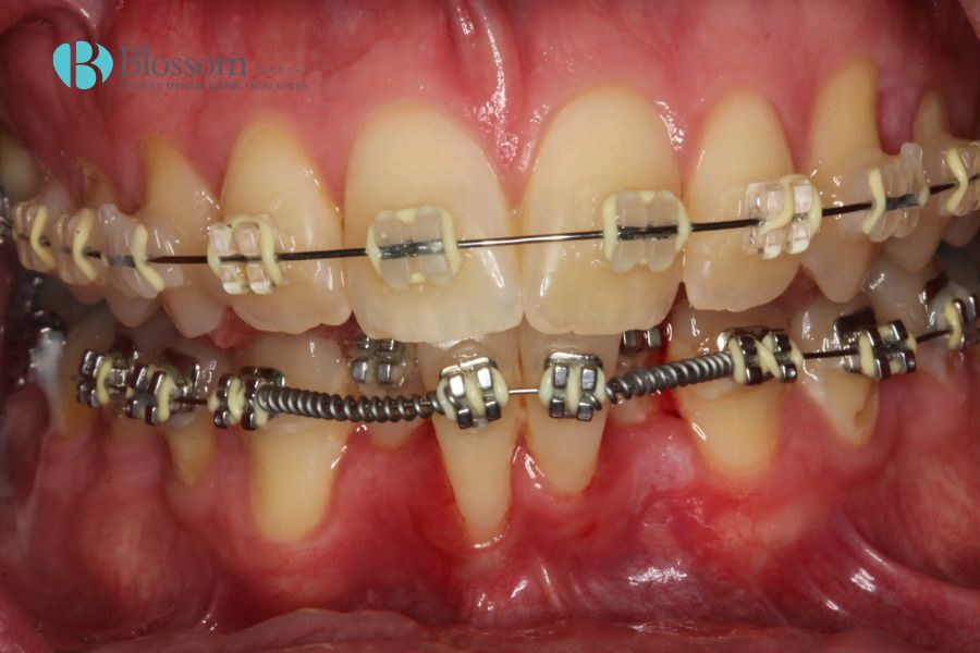 Răng bị xô lệch là gì? Nguyên nhân và cách điều trị hiệu quả 5 rang bi xo lech 4