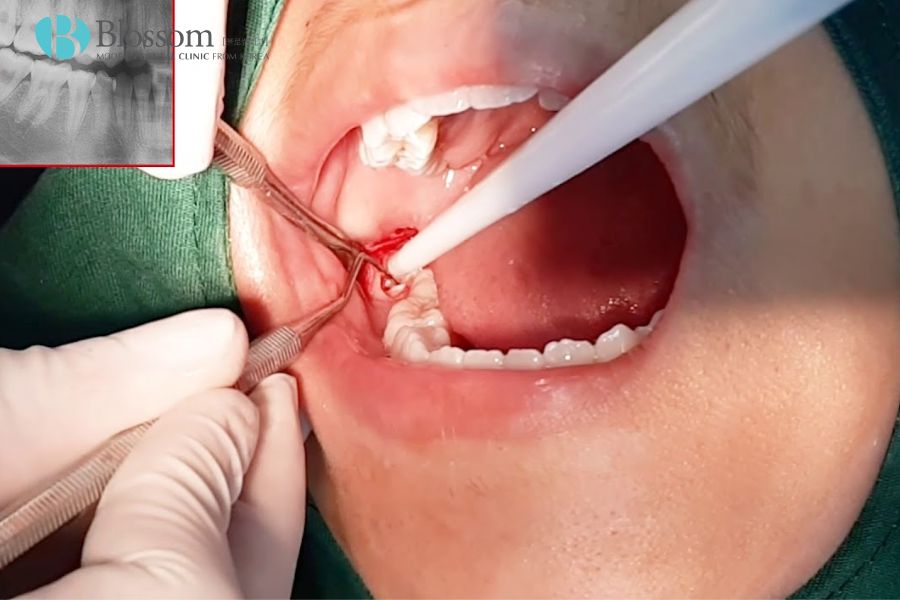 Răng bị xô lệch là gì? Nguyên nhân và cách điều trị hiệu quả 7 rang bi xo lech 7