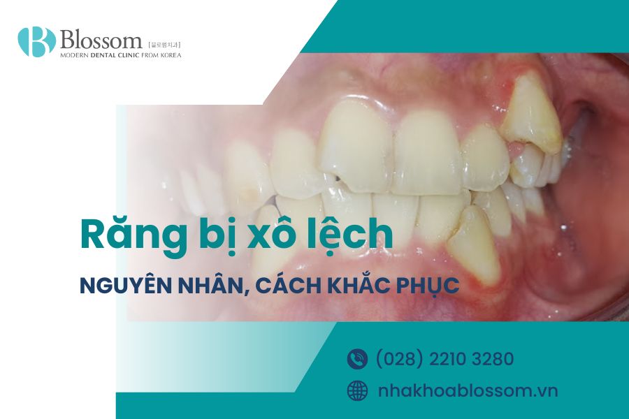 Răng bị xô lệch là gì? Nguyên nhân và cách điều trị hiệu quả