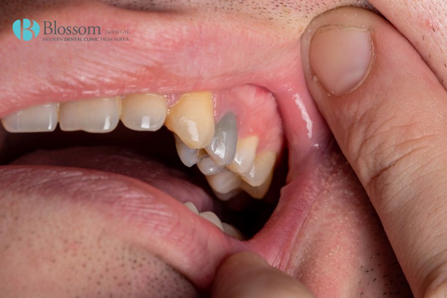 Phương pháp điều trị răng chết tủy hiệu quả hiện nay 4 rang chet tuy 3