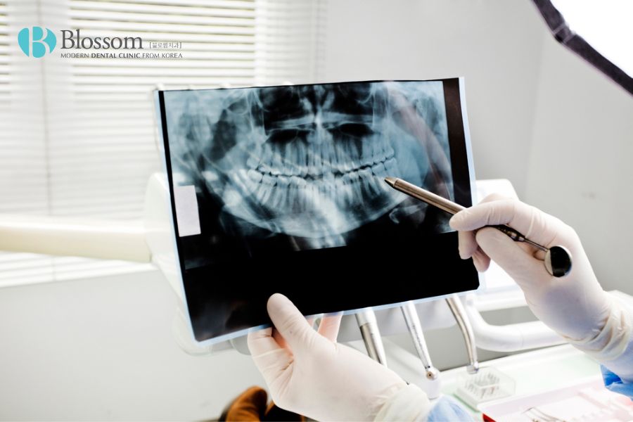 Phương pháp điều trị răng chết tủy hiệu quả hiện nay 5 rang chet tuy 4