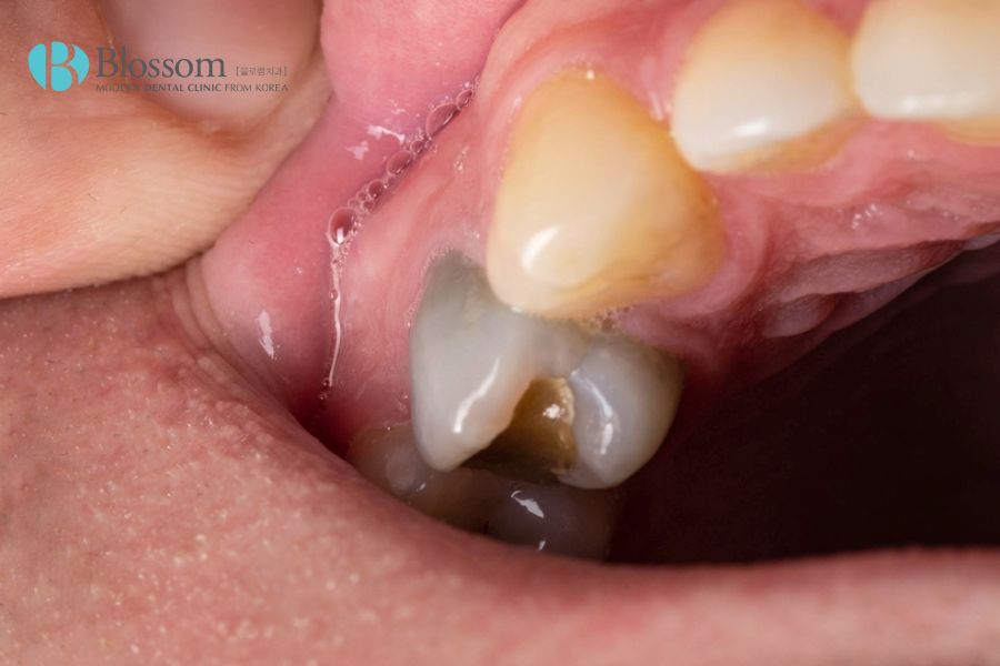 Phương pháp điều trị răng chết tủy hiệu quả hiện nay 7 rang chet tuy 6