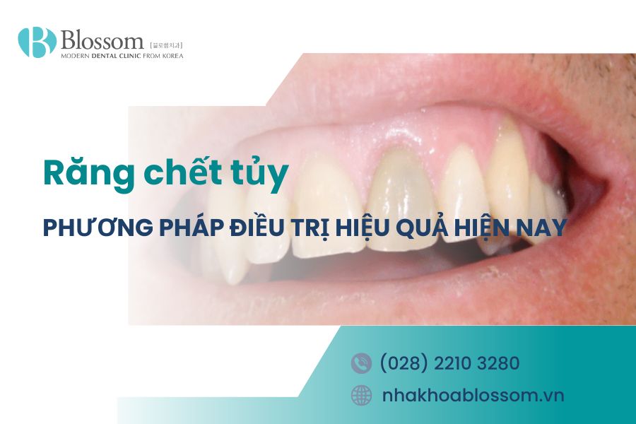 Phương pháp điều trị răng chết tủy hiệu quả hiện nay
