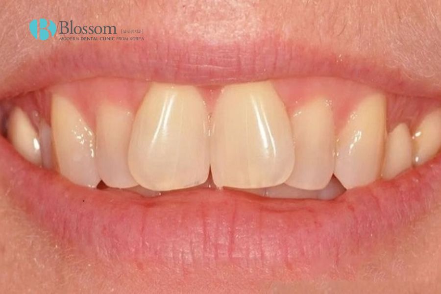 Răng cửa mọc lệch do đâu? Cách điều trị hiệu quả là gì? 3 rang cua moc lech 1