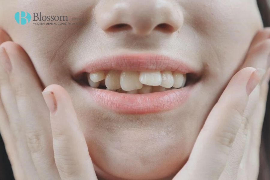 Răng cửa mọc lệch do đâu? Cách điều trị hiệu quả là gì? 2 rang cua moc lech 2