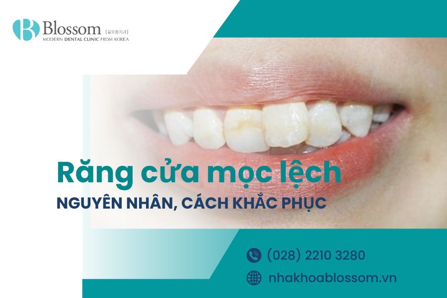 Răng cửa mọc lệch do đâu? Cách điều trị hiệu quả là gì? 1 rang cua moc lech