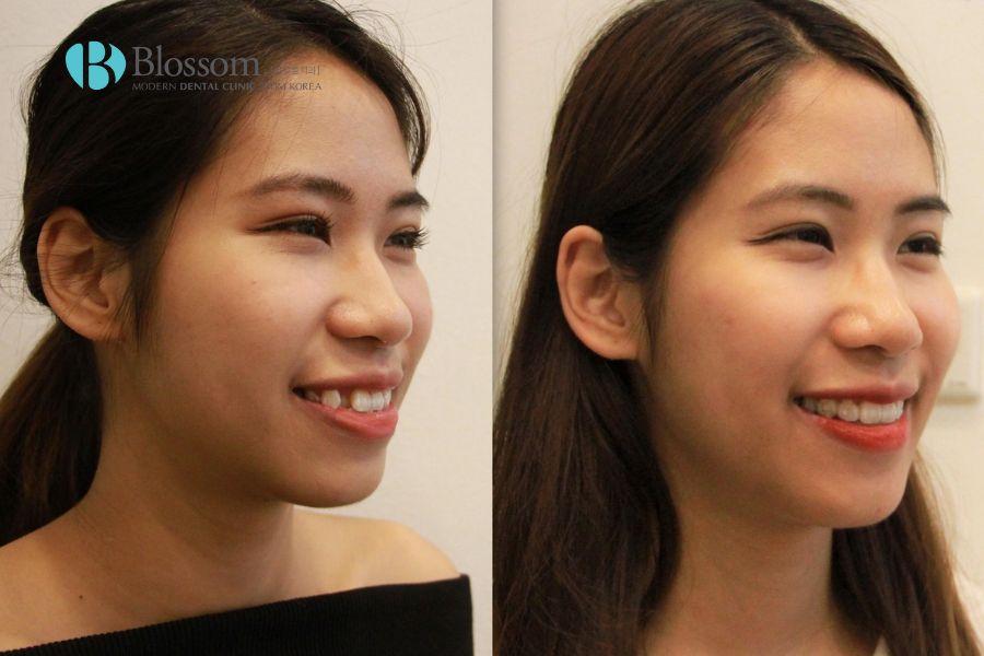 Răng khểnh đẹp hay xấu? Có nên nhổ răng hay niềng răng khểnh không? 10 rang khenh dep hay xau 3