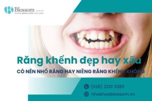Răng khểnh đẹp hay xấu? Có nên nhổ răng hay niềng răng khểnh không?