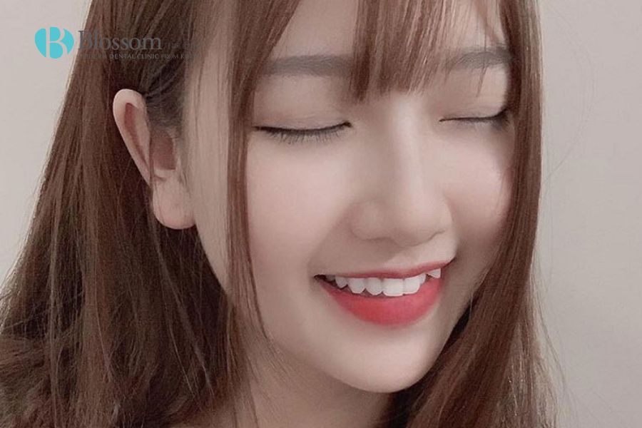 Răng khểnh đẹp hay xấu? Có nên nhổ răng hay niềng răng khểnh không? 3 rang khenh dep hay xau 4