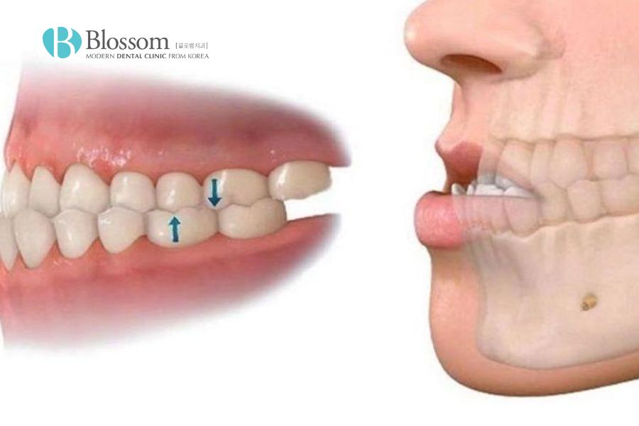Răng lệch hàm nguyên nhân do đâu? Đâu là cách điều trị hiệu quả 4 rang lech ham 3