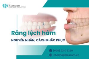 Răng lệch hàm nguyên nhân do đâu? Đâu là cách điều trị hiệu quả