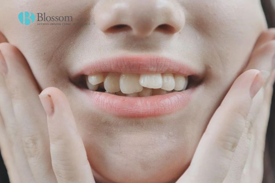 Răng lệch hàm nguyên nhân do đâu? Đâu là cách điều trị hiệu quả 6 rang lech ham 5