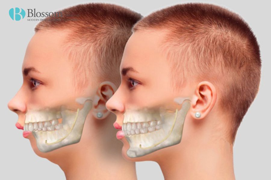 Răng lệch hàm nguyên nhân do đâu? Đâu là cách điều trị hiệu quả 9 rang lech ham 8