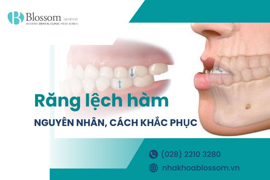 Răng lệch hàm nguyên nhân do đâu? Đâu là cách điều trị hiệu quả 1 rang lech ham