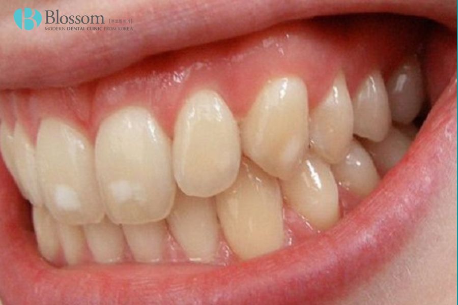 Răng nhiễm Fluor là gì? Cách điều trị như thế nào? 2 rang nhiem fluor la gi 1