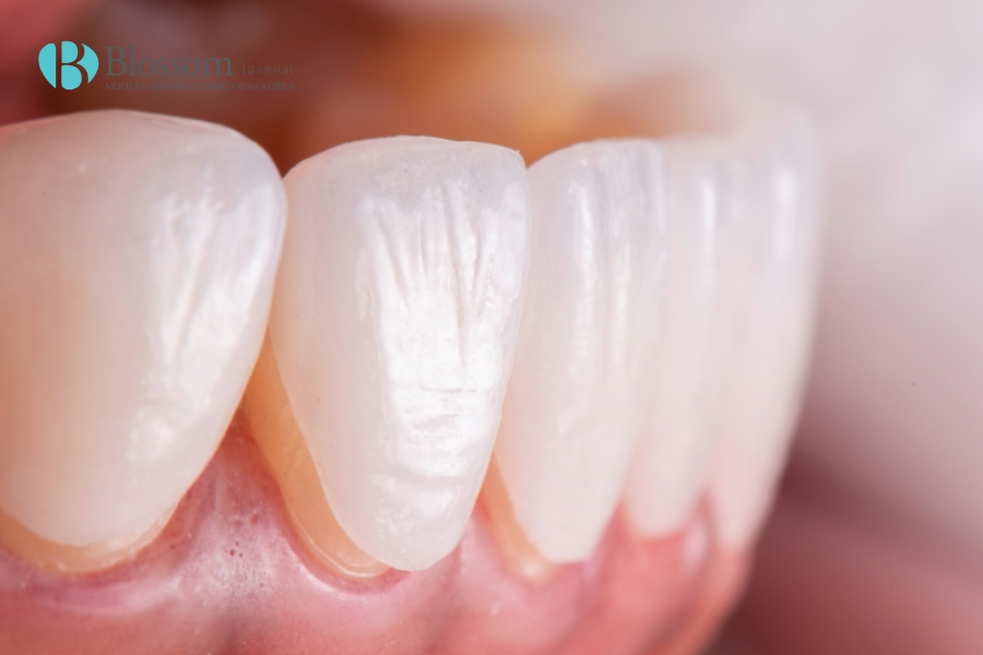 Răng nhiễm kháng sinh là gì? Giải pháp nào điều trị hiệu quả 6 rang nhiem khang sinh 7
