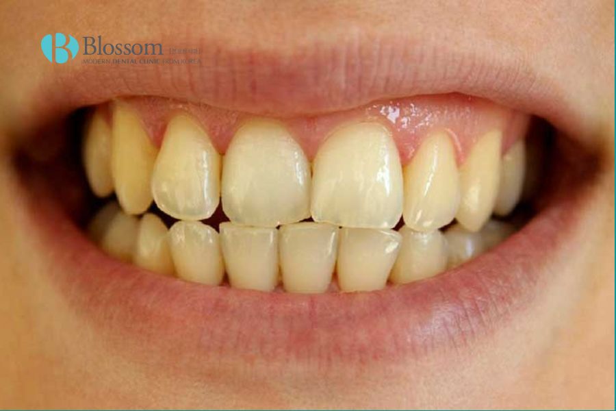 Vì sao răng bị ố vàng? Nguyên nhân và cách khắc phục như thế nào? 5 rang o vang 1