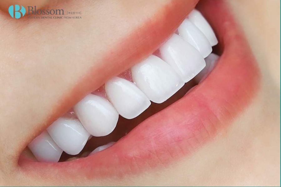 Vì sao răng bị ố vàng? Nguyên nhân và cách khắc phục như thế nào? 11 rang o vang 11