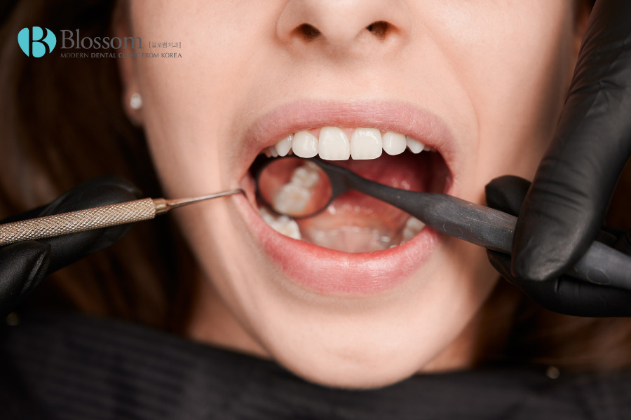 Răng sâu đau nhức là gì? Nguyên nhân và hướng điều trị ra sao? 2 rang sau dau nhuc 1