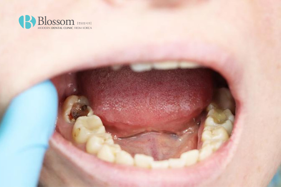 Răng sâu đau nhức là gì? Nguyên nhân và hướng điều trị ra sao? 5 rang sau dau nhuc 5