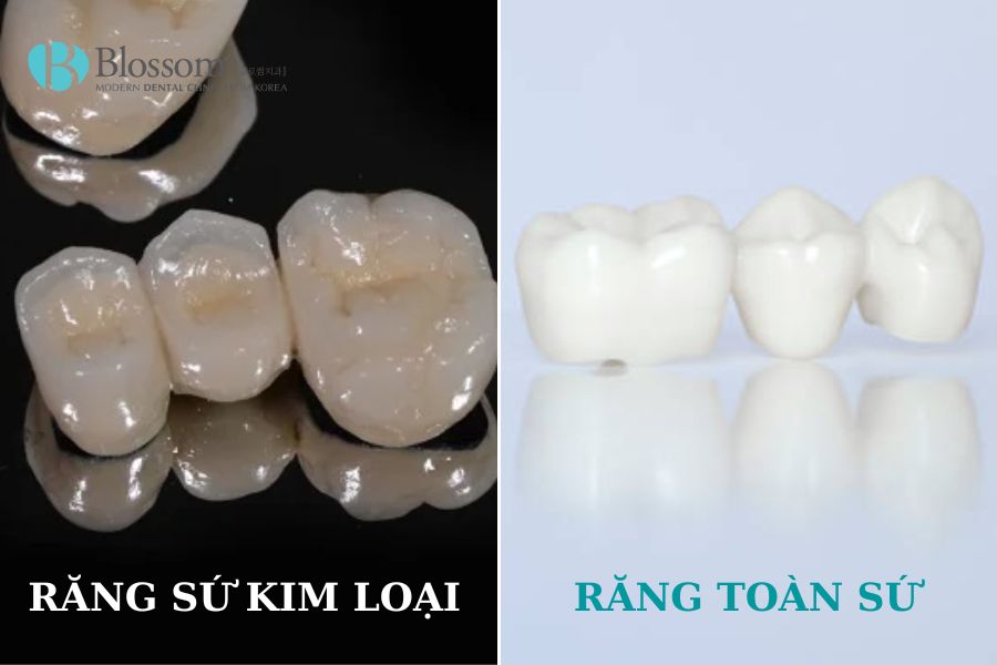 rang su kim loai va rang toan su 4