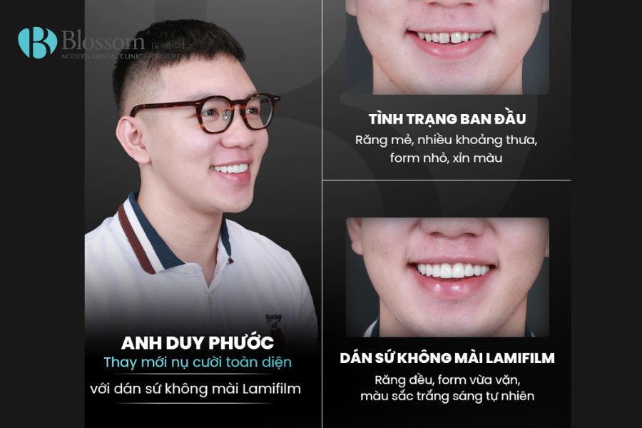 rang su kim loai va rang toan su 6