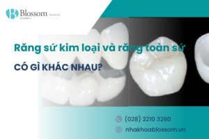 Răng sứ kim loại và răng toàn sứ: Có gì khác nhau?