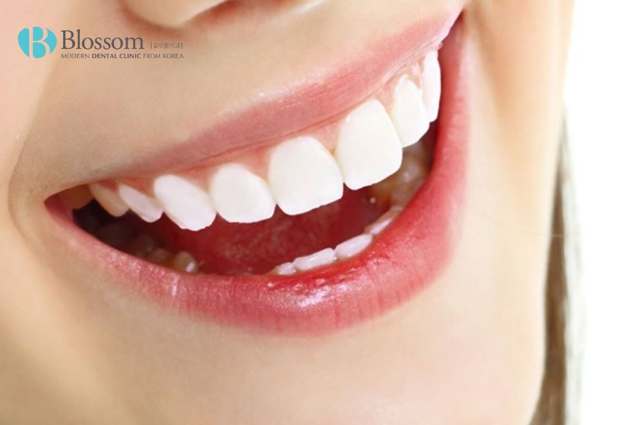 Răng sứ Lava là gì? Phân loại, quy trình và giá thành hiện nay 6 rang su lava la gi 5
