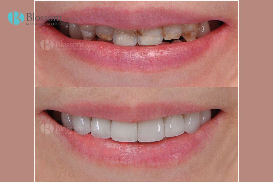 Răng sứ Lava là gì? Phân loại, quy trình và giá thành hiện nay 9 rang su lava la gi 8