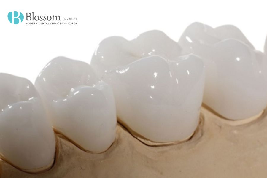 Răng sứ Venus: Ưu - nhược điểm, chi phí thực hiện 2 rang su venus 1