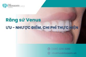 Răng sứ Venus: Ưu – nhược điểm, chi phí thực hiện