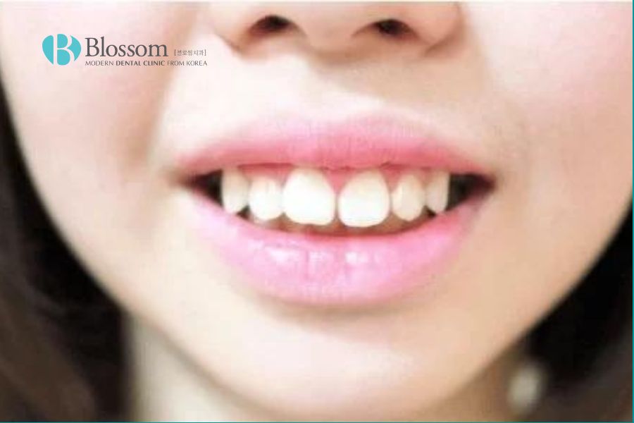 Răng vẩu là gì? Các loại răng vẩu thường gặp 2 rang vau la gi 1