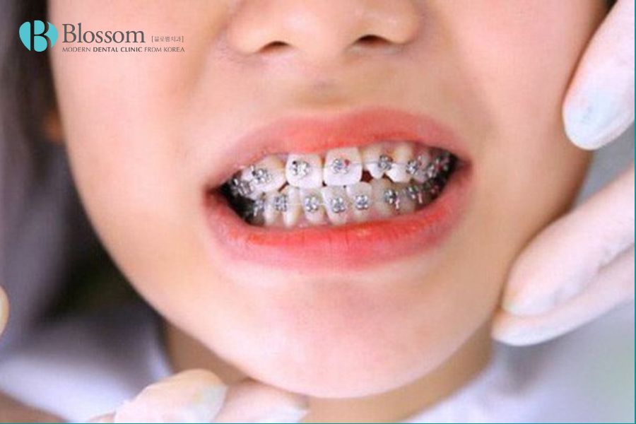 Răng vẩu là gì? Các loại răng vẩu thường gặp 11 rang vau la gi 10