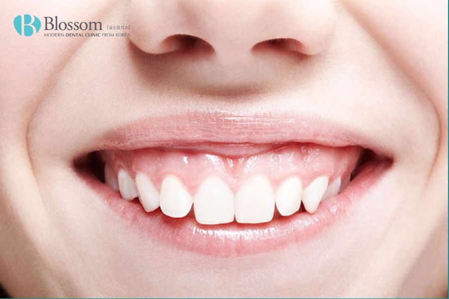 Răng vẩu là gì? Các loại răng vẩu thường gặp 5 rang vau la gi 4